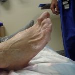 Sherry's Hammer Toe